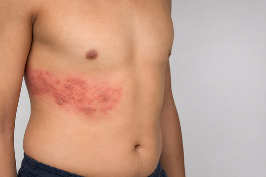 Shingles rash band on one side of torso