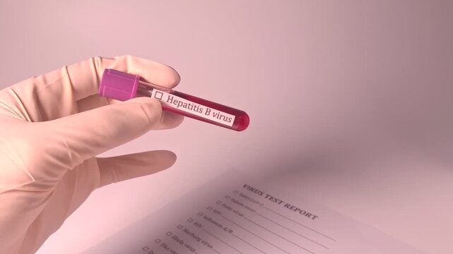 Medical professional wearing gloves holds a blood sample labeled Hepatitis B virus next to a virus test report form for diagnosis and research