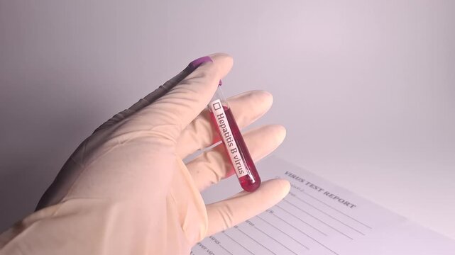 Medical professional analyzes a blood sample in a vial labeled Hepatitis B virus next to a virus test report form for diagnostic purposes