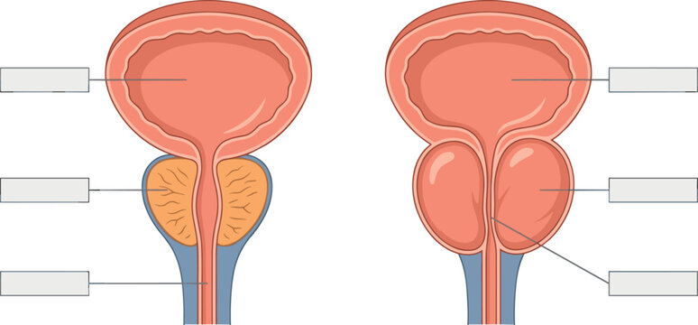 Prostate Anatomy Diagram Comparing Healthy Gland Structure with Benign Prostatic Hyperplasia Enlargement and Blank Labels for Medical Urology Education Infographics