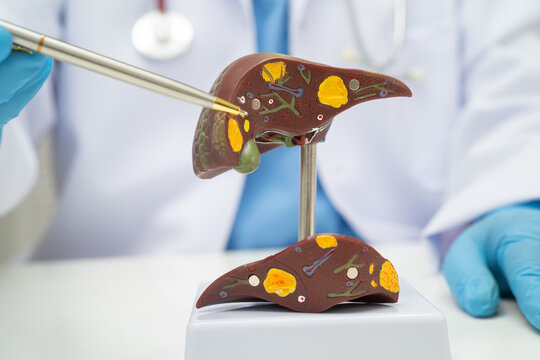 Cirrhosis, Liver cancer, fatty liver, Asian doctor with liver human model.