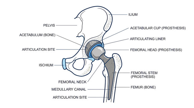 Hip Joint Anatomy with Prosthesis Diagram