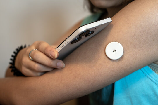 Teenage girl looking at her smartphone screen to monitor glucose levels using a health app. A white sensor patch is visible on her upper arm. Diabetes management, health technology, and telemedicine