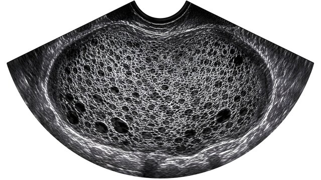 Hydatidiform Mole Ultrasound Appearance, Molar Pregnancy Sonography, Realistic OB-GYN Diagnostic Scan