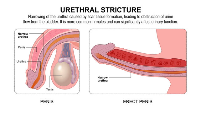 Urethral Stricture, Penis Flashcard Illustration