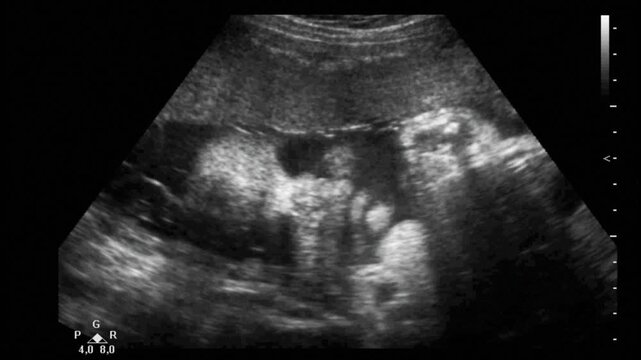 Medical ultrasound sonogram scan of a developing fetus moving inside the mother's womb, showing the head cross-section and body profile