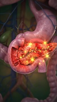 Human pancreatic anatomy, showing severe inflammation, depicting pancreatitis, a serious digestive system disorder, major medical health condition