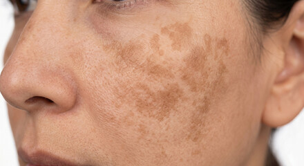 Melasma Macule (Facial Hyperpigmentation) - Macule in Human Skin — Medical Dermatology Plate...
