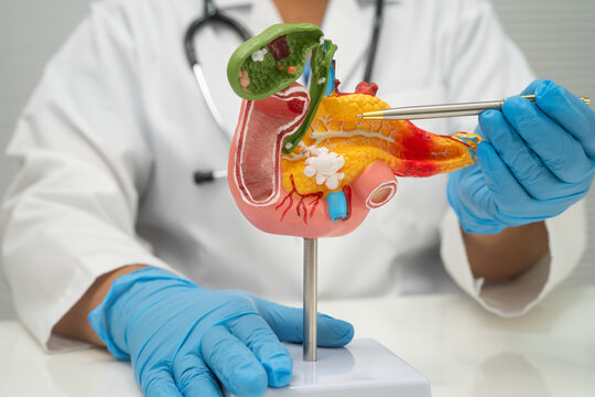Pancreatitis, pancreatic cancer, Asian doctor with pancreas, gallbladder and bile duct human anatomy model at hospital.