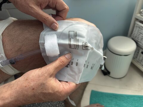 A pair of male hands can be seen attaching a urinary catheter bag his leg. Urology . Medical . Health