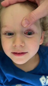 Toddler with subconjunctival hemorrhage in red eye being examined by parent. Child eye injury or health concern evaluation. Medical checkup for eye condition.