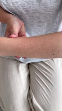 Vertical video. A woman with sunburned skin, peeling, dry skin. Close-up of the forearm after sunburn, a consequence of excessive exposure to ultraviolet rays