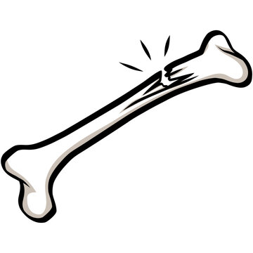 Greenstick Fracture Bone Illustration Vector
