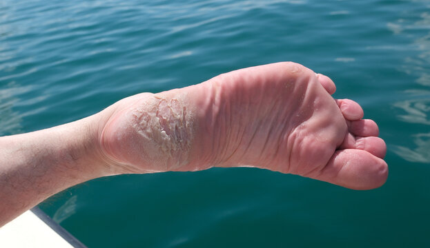Hyperkeratose Hautkrankheit, vom Wasser aufgeweichte Fu&szlig; Fersen Hornhaut wo teils mit Nagelschere bereits entfernt wurde