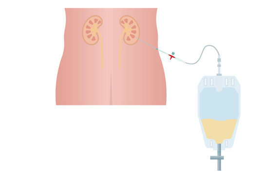 Medical Diagram of Kidney Catheter with Drainage Bag