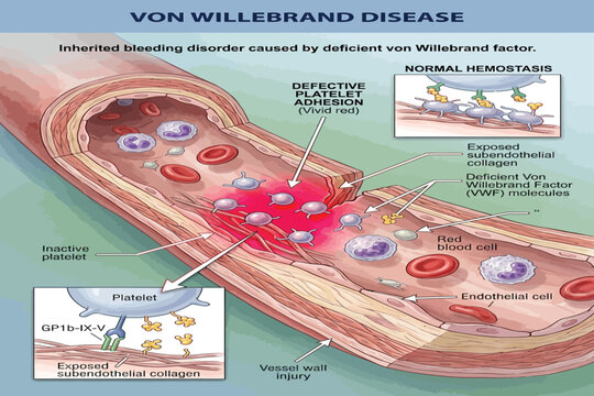 Diagram showing defective platelet adhesion in Von Willebrand Disease.