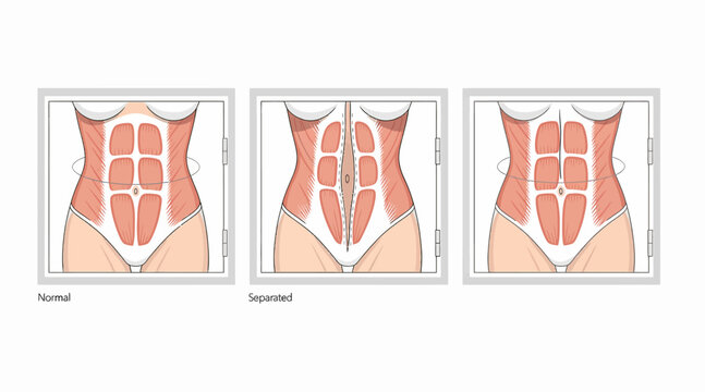 Abdominal muscle anatomy, diastasis recti
