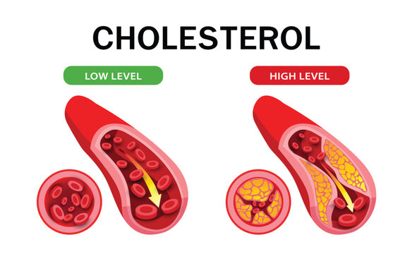 Cholesterol Level Comparison Infographic Illustration, health risk , vector design