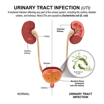 Urinary Tract Infection (UTI), Urine Infection Illustration