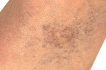 Fototapeta premium Spider veins and blood vessel issues in an adult male foot caused by chronic venous insufficiency, resulting in poor circulation.