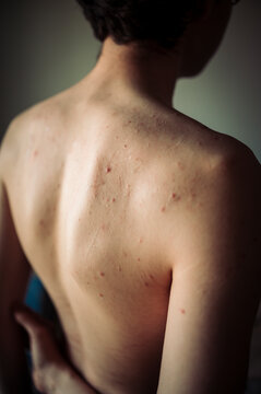 Rear view of bare back with acne and problem skin