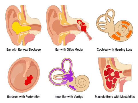 Medical illustration set showing common human ear disorders and conditions including earwax blockage otitis media hearing loss perforation