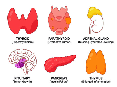 Medical illustration showing endocrine gland pathologies including thyroid hyperthyroidism parathyroid tumor adrenal gland swelling