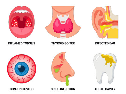 Medical infographic set showing common human health conditions including tonsillitis thyroid goiter ear infection conjunctivitis sinusitis