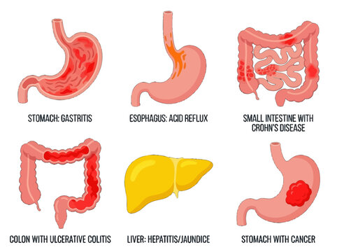 Medical infographic set illustrating common human digestive system diseases including gastritis acid reflux crohn's disease colitis hepatitis