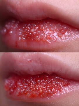 Macro view of a severe herpes simplex virus (HSV) outbreak on human lips, showing numerous fluid-filled blisters