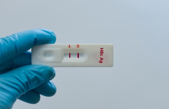 Blood sample of patient positive result for HBc Ag.