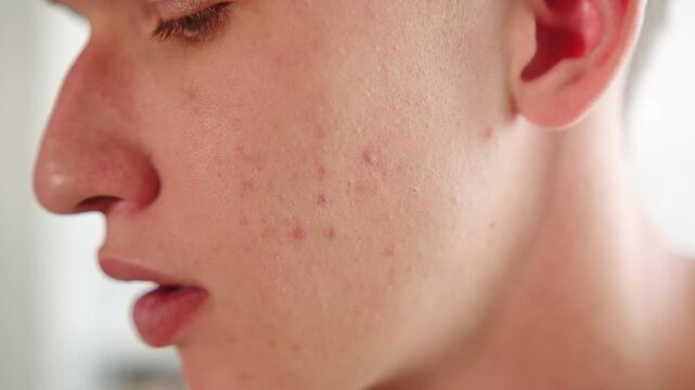 Boy with acne. Acne breakouts  on a young man&rsquo;s cheek with skin texture blemishes. Men&rsquo;s hand goes over his face with red inflammatory papules. Men&rsquo;s skin care.