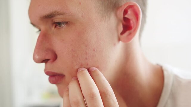acne on a man's skin, skin texture blemishes. Men touching his face with red inflammatory papules. Men&rsquo;s skin care.