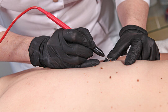 Man undergoing procedure to remove warts and papillomas. Laser cauterization of benign growths on skin. Laser removal of papillomas on skin. Aesthetic medicine. Prevention of melanoma