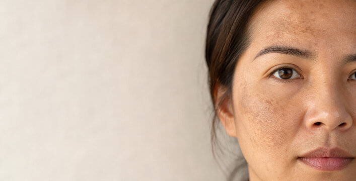 Woman with facial melasma and and hyperpigmentation, natural skin texture. For skincare, dermatology, beauty, and beauty awareness.