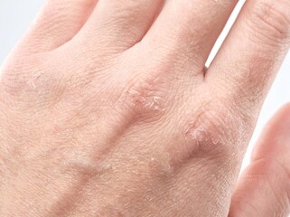 Fototapeta premium Close up of severely dry, cracked, and flaky skin on the back of an aging hand