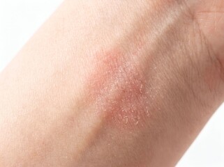Fototapeta premium Close up of itchy allergic rash on the arm