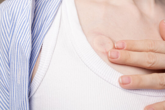 close-up of a woman's hand touching an implanted chest port, capturing self monitoring, sensitivity and routine body awareness during chemotherapy treatment