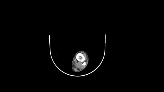 3D CT Reconstruction of the Left Ankle 