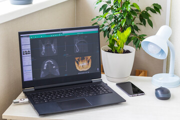 Fototapeta premium Black laptop computer screen displaying dental 3D CBCT tomography diagnostic software on a home office desk with houseplants. Healthcare