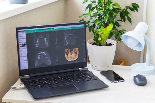 Black laptop computer screen displaying dental 3D CBCT tomography diagnostic software on a home office desk with houseplants. Healthcare