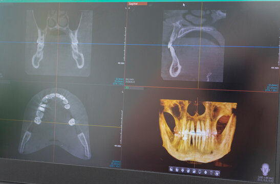 Dental cone beam computed tomography or CBCT diagnostic scan software displaying multi-planar views and a 3D maxillofacial reconstruction model. Healthcare