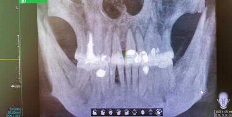 Panoramic view of a digital dental X-ray displaying the maxillofacial structure, teeth roots, and dental crowns on a diagnostics monitor. Dental © Four_Lakes
