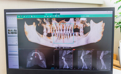 Laptop screen displaying professional dental diagnostic software with a 3D panoramic jawbone model and cross-sectional root slices. Dental © Four_Lakes