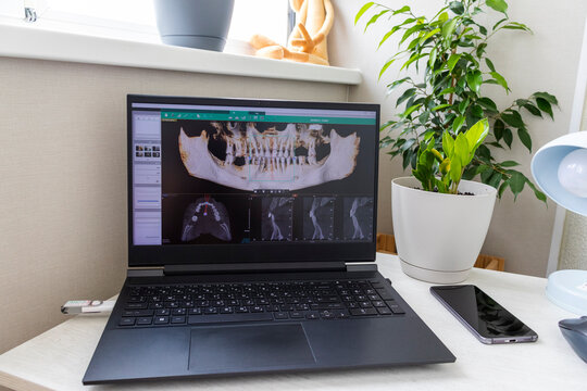 Laptop screen displaying professional dental diagnostic software with a 3D panoramic jawbone model and cross-sectional root slices. Dental