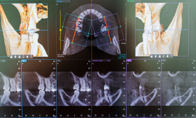 Laptop screen displaying professional dental diagnostic software with a 3D panoramic jawbone model and cross-sectional root slices. Dental © Four_Lakes
