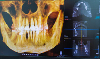 Dental CBCT software interface featuring a 3D volumetric maxillofacial reconstruction alongside axial, sagittal, and coronal multi-planar slices. dental © Four_Lakes