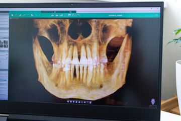 Laptop screen displaying professional dental diagnostic software with a 3D panoramic jawbone model and cross-sectional root slices. Dental © Four_Lakes