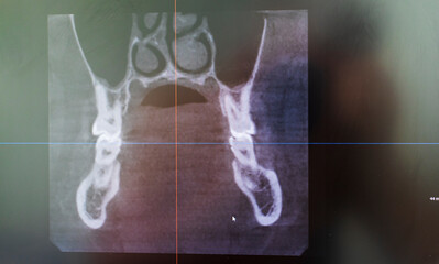 Dental CBCT software interface featuring a 3D volumetric maxillofacial reconstruction alongside axial, sagittal, and coronal multi-planar slices. dental © Four_Lakes