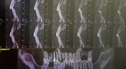 Dental CBCT software interface featuring a 3D volumetric maxillofacial reconstruction alongside axial, sagittal, and coronal multi-planar slices. dental © Four_Lakes